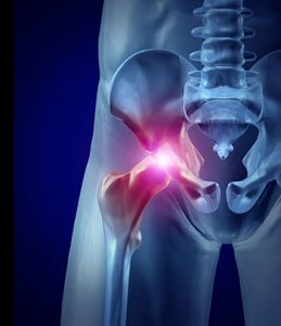 Hip Bursitis Vs Arthritis How To Tell The Difference Heiden Orthopedics