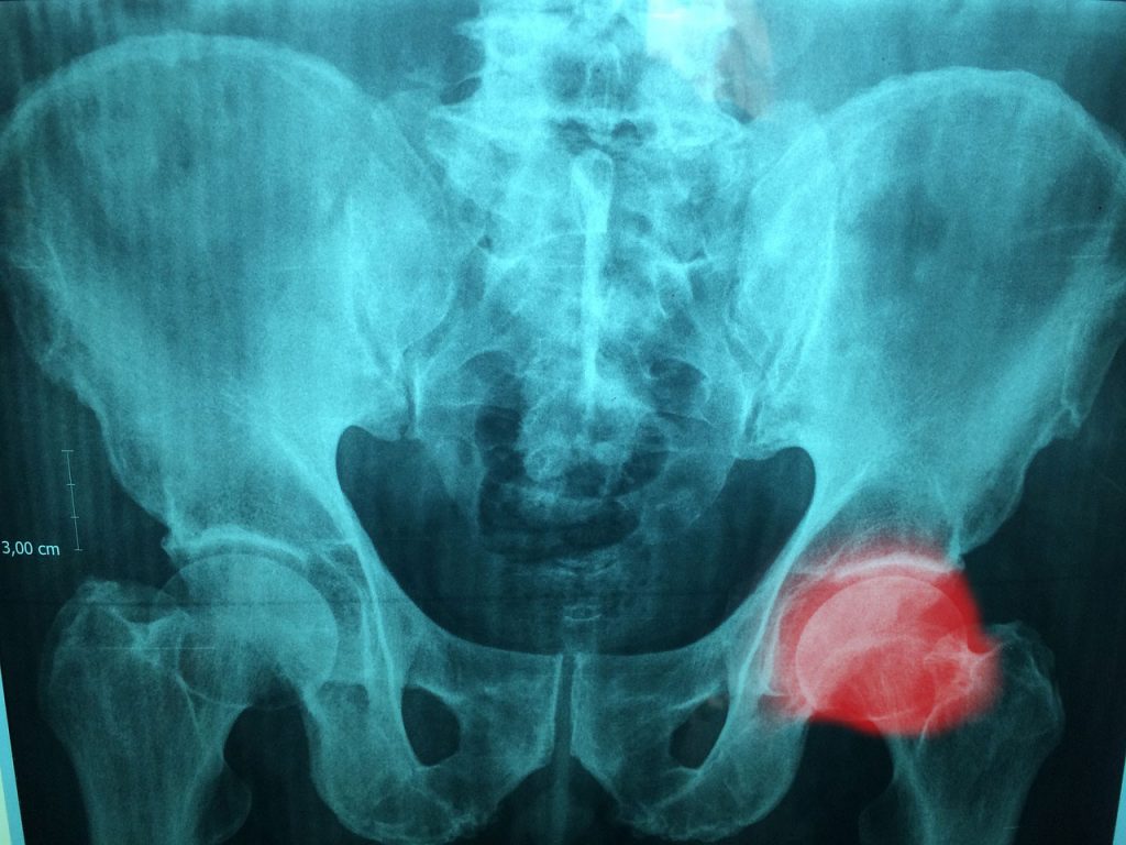 normal hip xray with pain and weakness