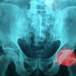 hip pain x-ray
