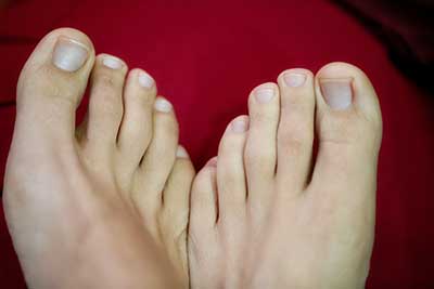 The Consequences of Hammertoe