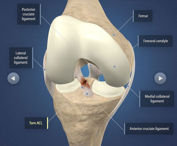 How To Tell If You Tore Your Acl After Surgery