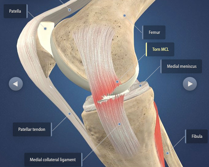 Medial Collateral Ligament (MCL) Injury  Central Coast Orthopedic Medical  Group