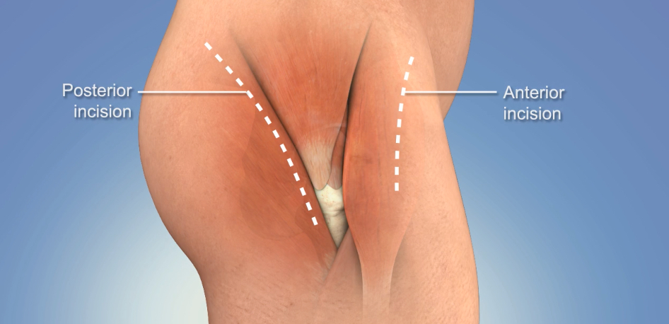 What is Total Hip Replacement Surgical Procedure?