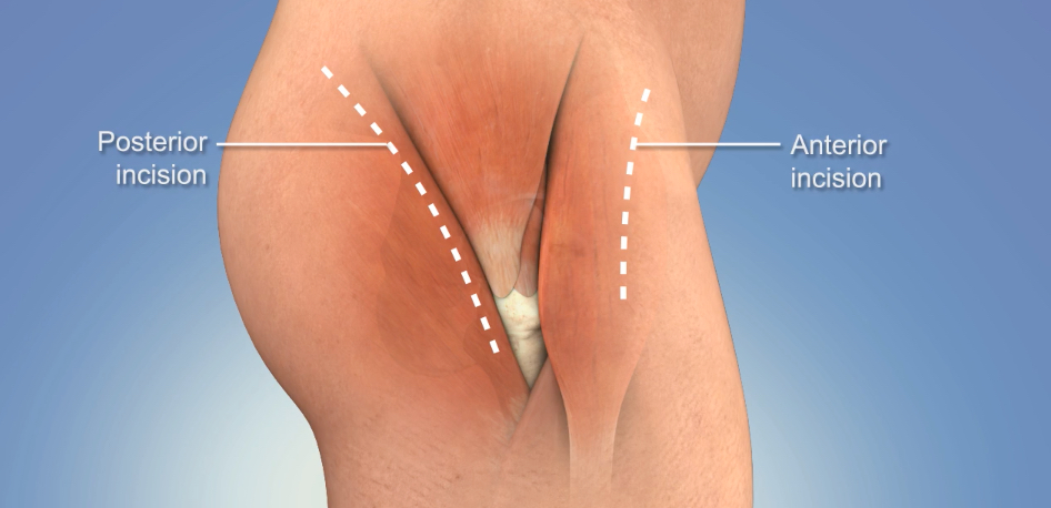 Total Hip Replacement, Anterior Approach