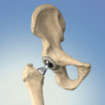 Total Hip Replacement Surgery: What to Expect