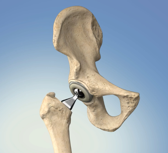 Total Hip Replacement Surgery: What to Expect - Heiden Orthopedics