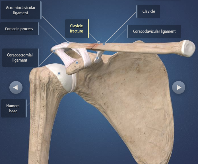 Clavicle Fractures - Heiden Orthopedics