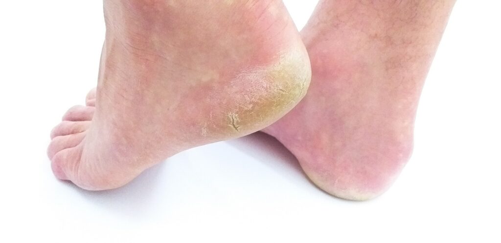 High Arch Feet (Cavus Foot): What Is It, Symptoms, Causes & Treatment