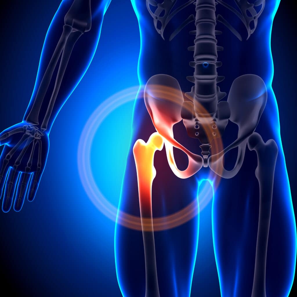 Hip Osteoarthritis  Orthopedics Sports Medicine