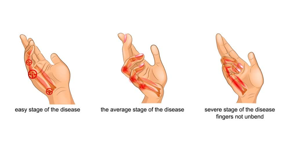 Trigger Finger: Symptoms, Causes & Treatments