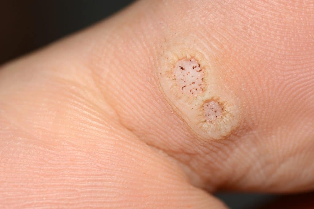 Plantar Warts