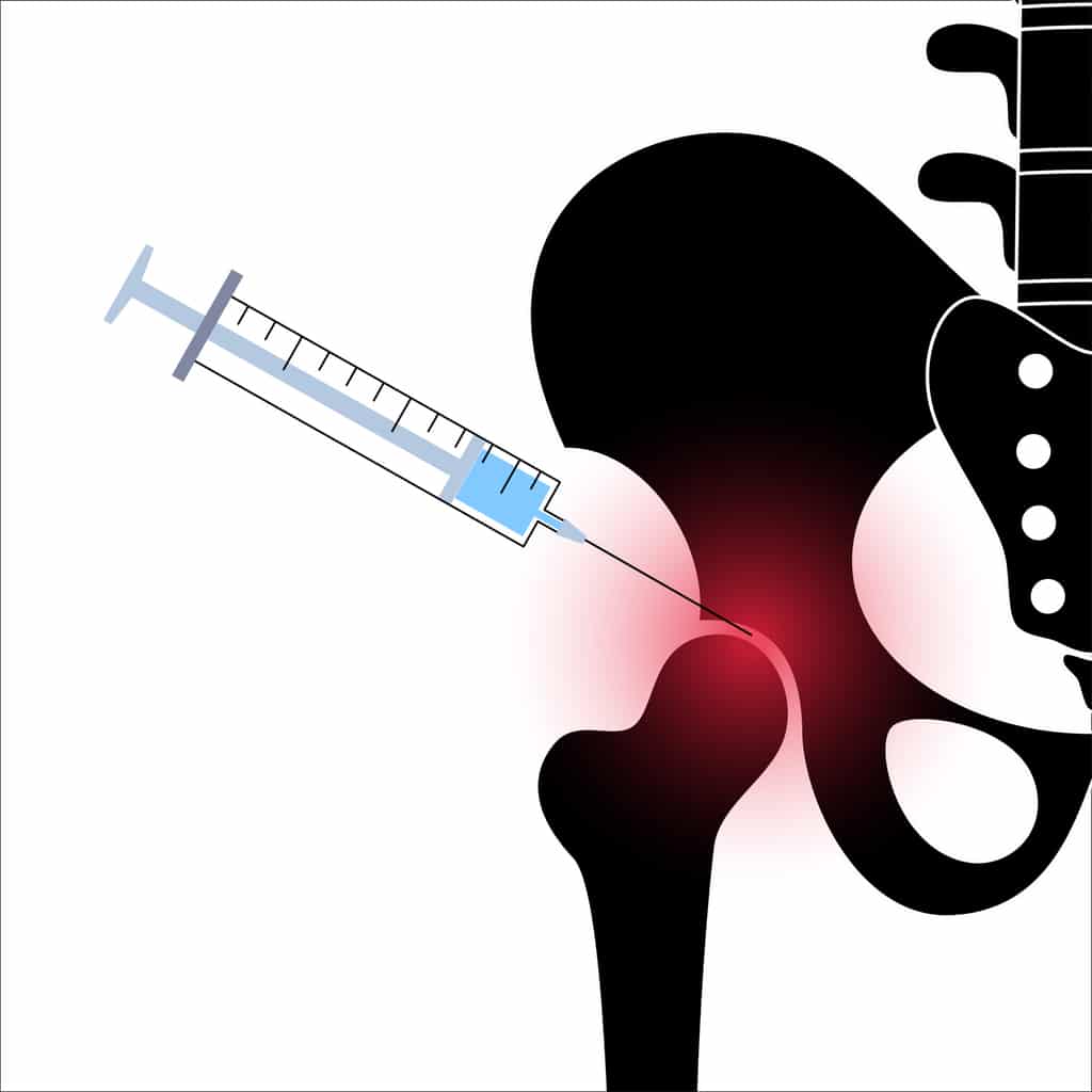 injection in hip