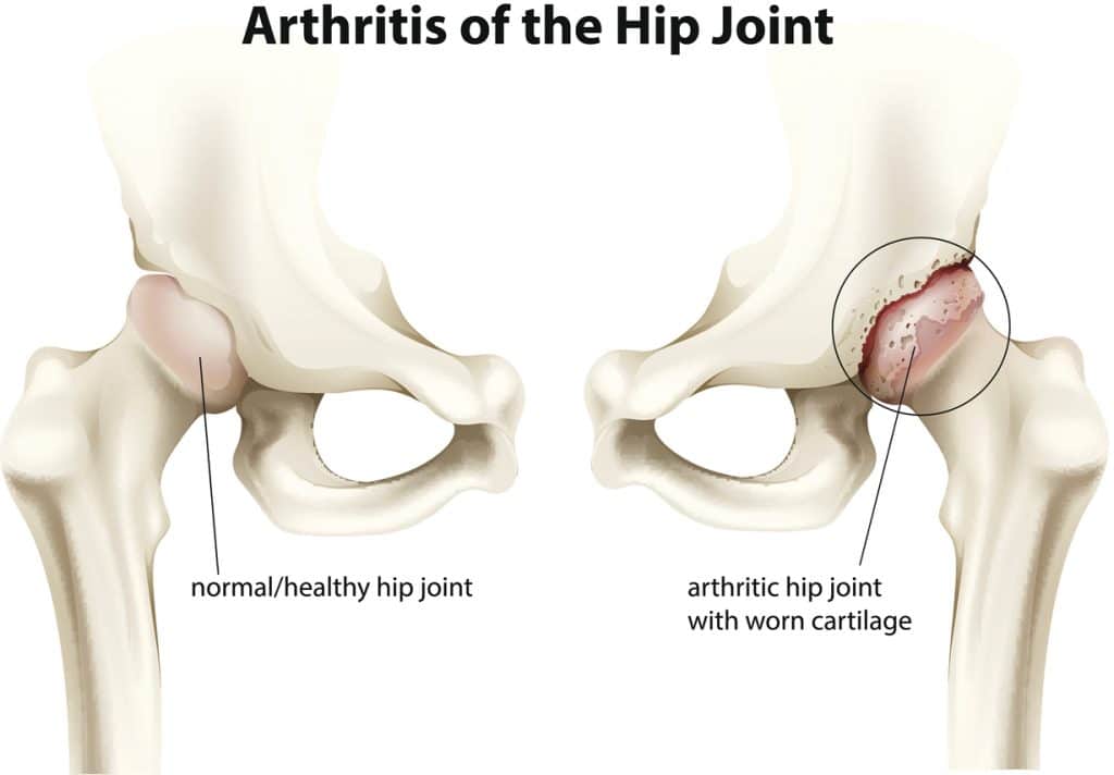 hip osteoarthritis