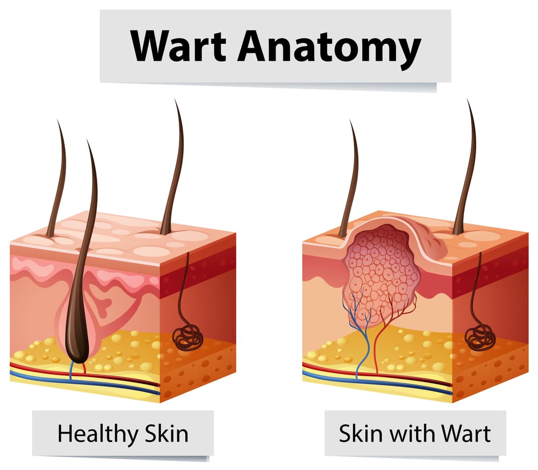 What Does A Wart Look Like Under A Microscope Infoupdate What Does A Wart Look Like Under A Microscope Infoupdate