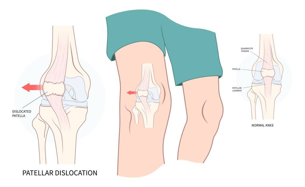 My knee cap keeps on sale dislocating