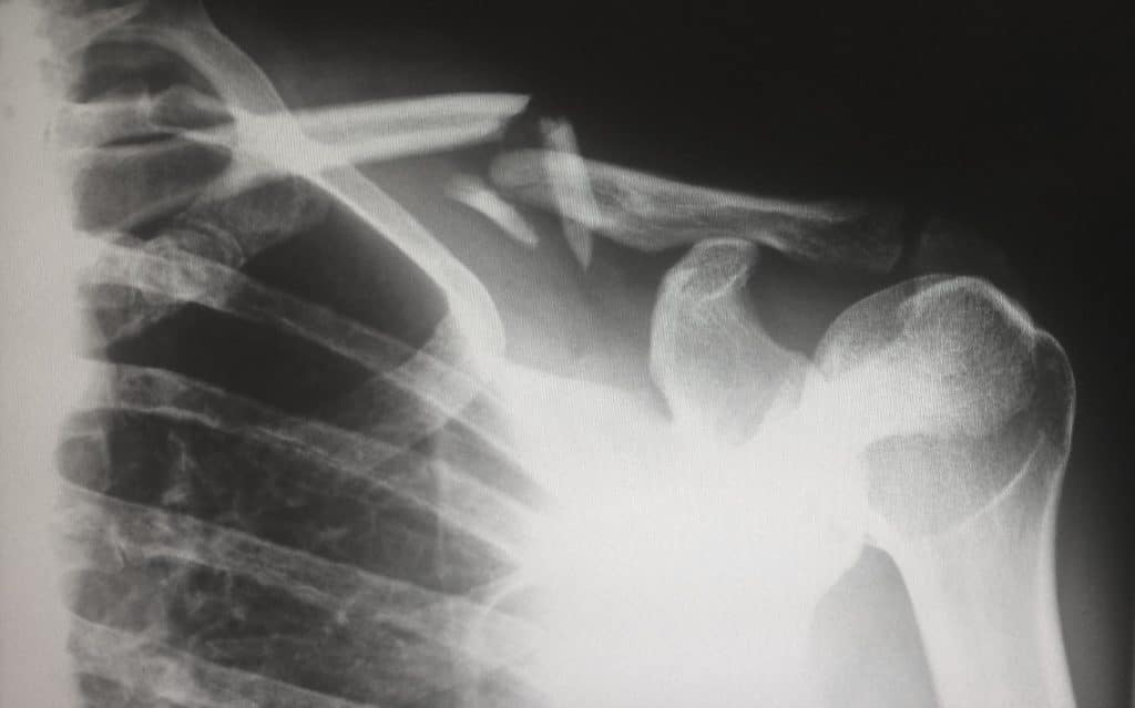 clavicle fracture