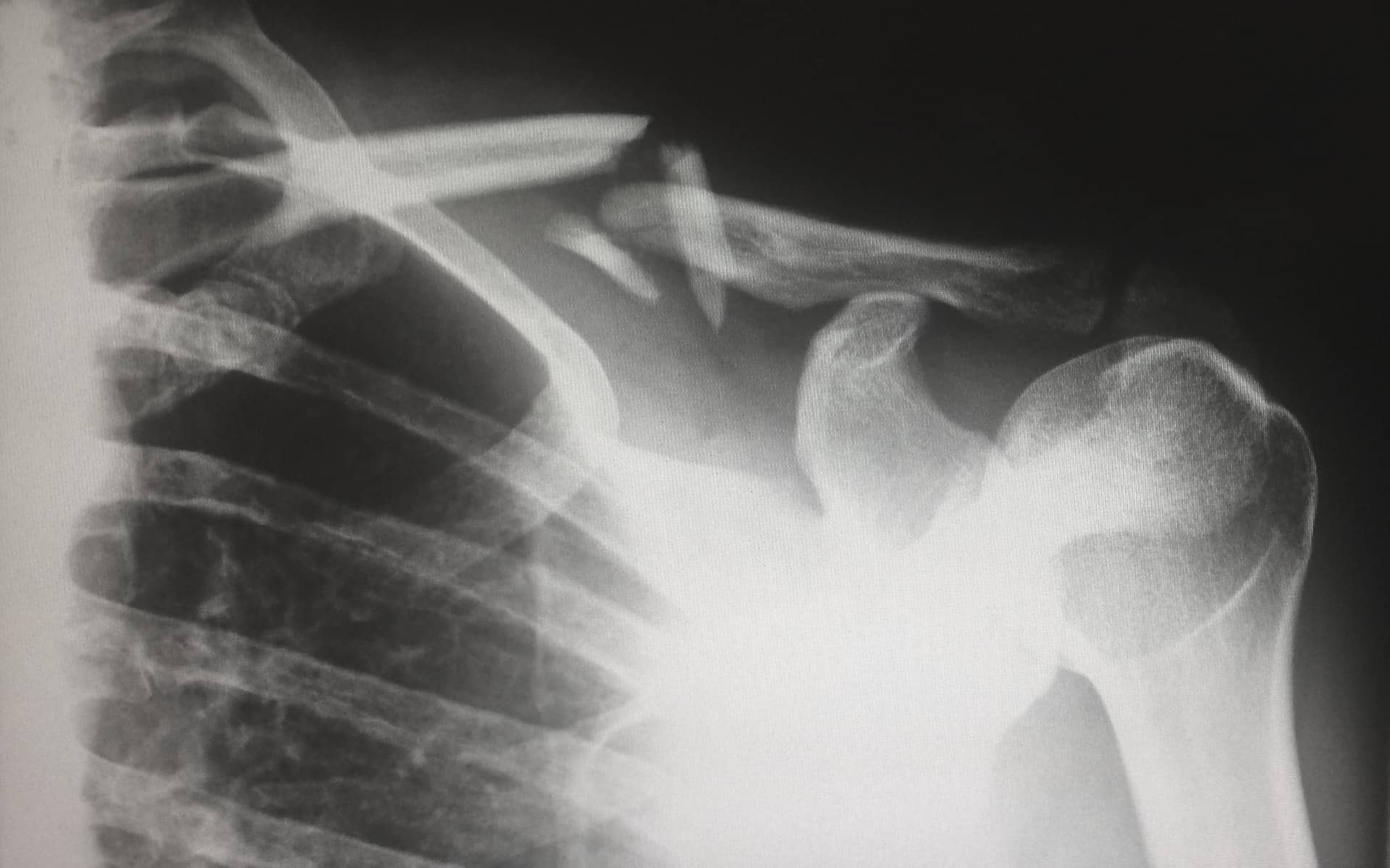 clavicle bone x ray