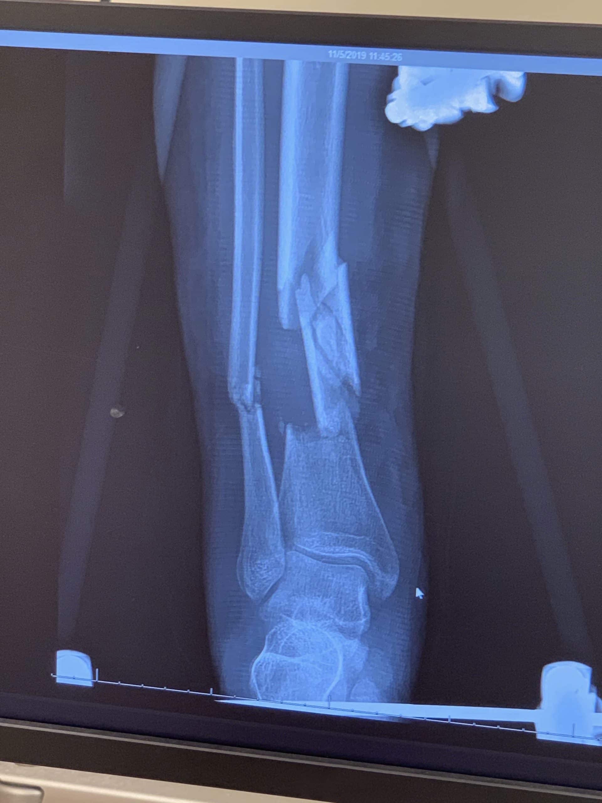 x ray broken foot