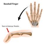 Baseball finger