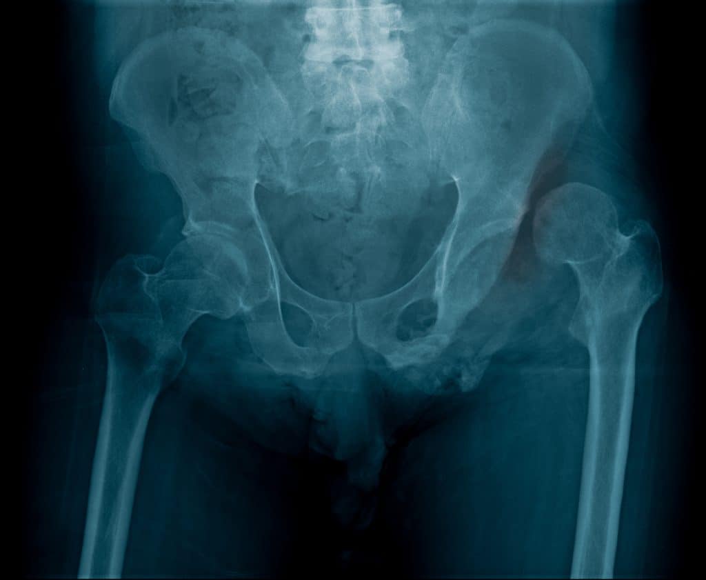 The Process Of Hip Replacements - Put The Spring Back In Your Step