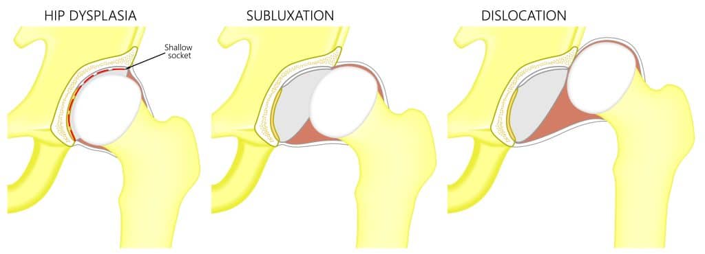 hip dysplasia hip dislocation hip subluxation