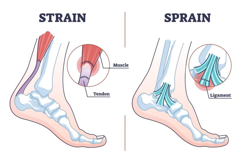 Sprain vs strain anatomical comparison