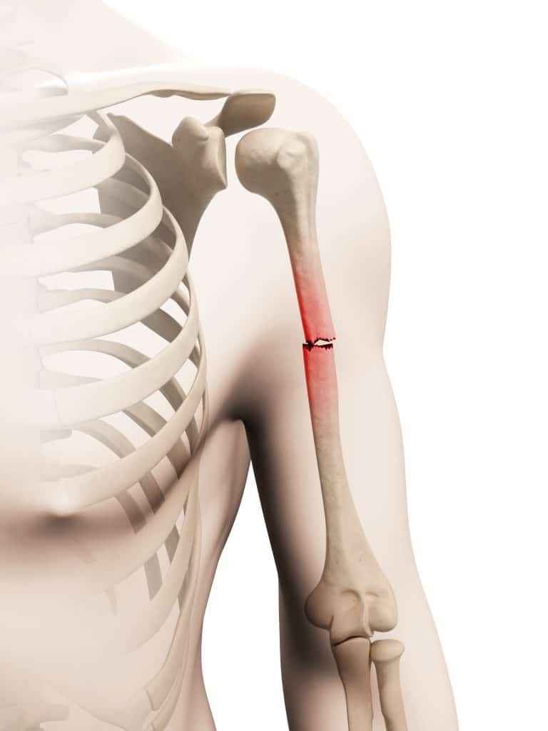 medical illustration of a borken arm bone