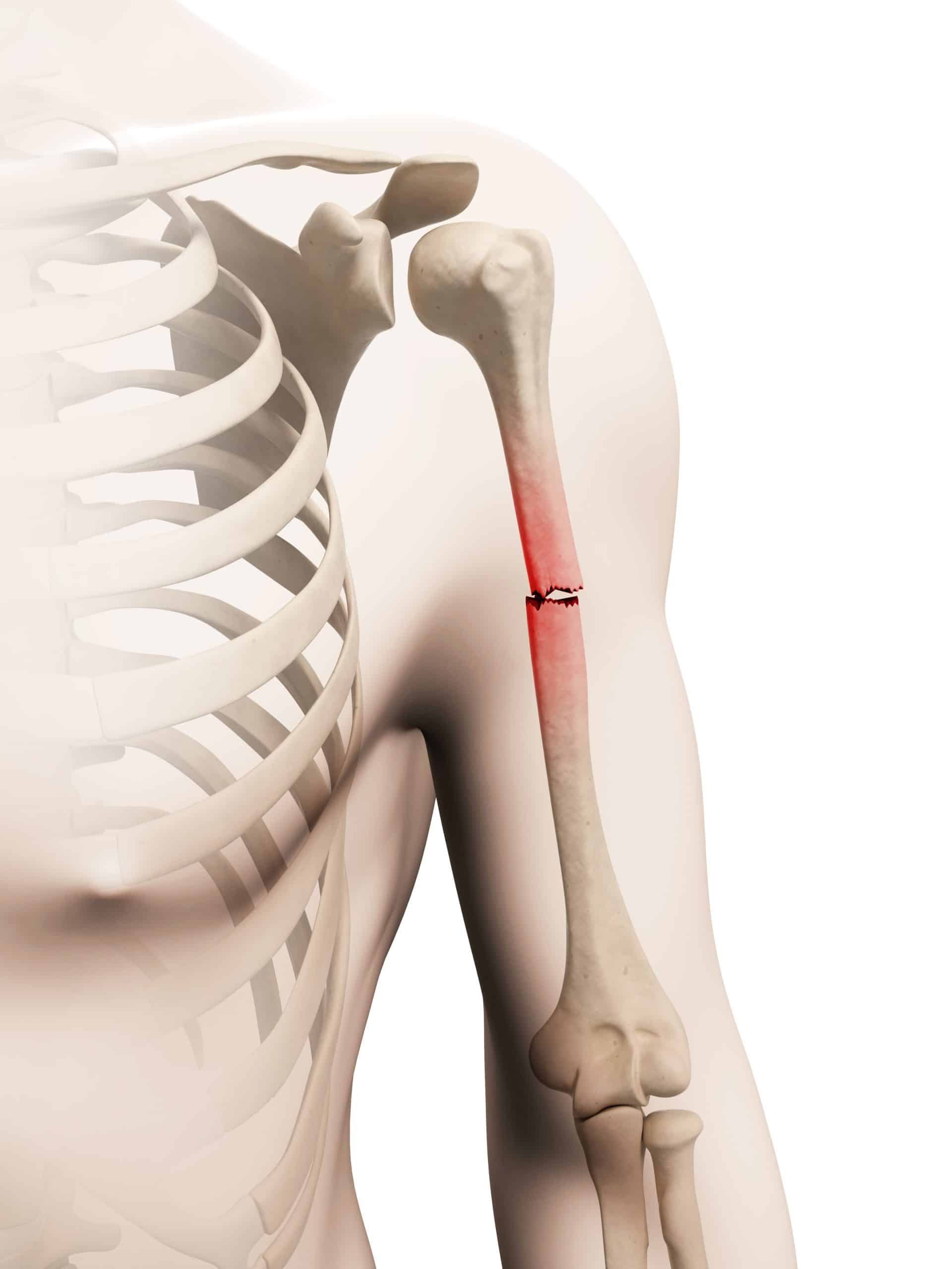 How Long Does It Take A Humerus Fracture To Heal Heiden Orthopedics