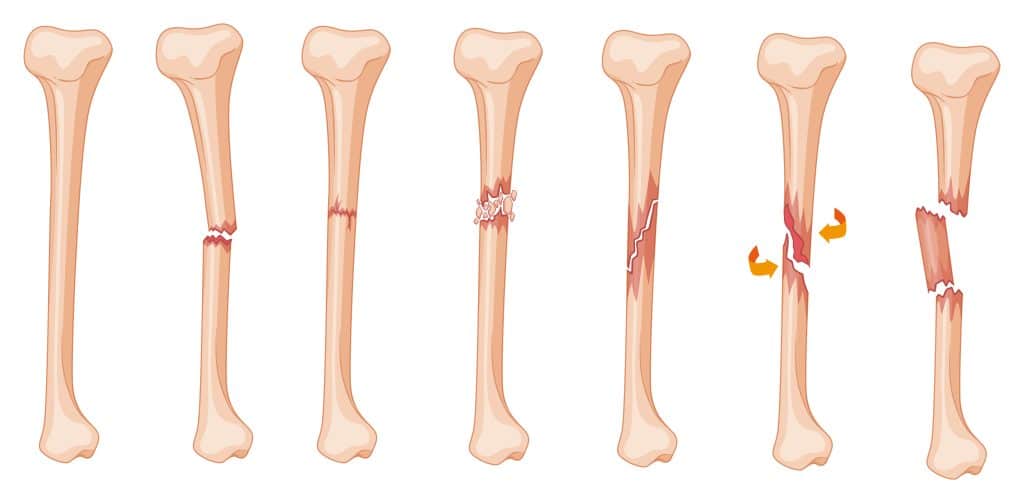 Diagram of leg fracture in different stages illustration