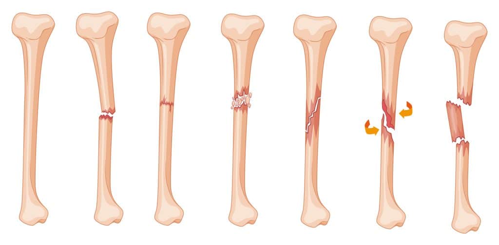 Lower leg fracture