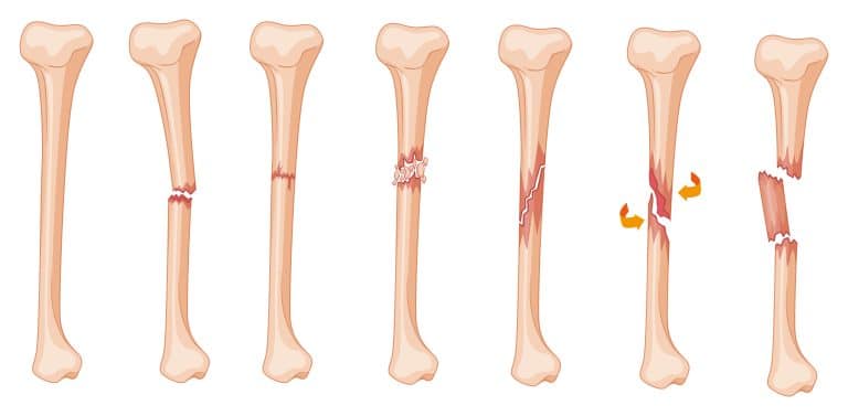Splintered Tibia Tibia Fractures: Types, Symptoms, & Treatments - Heiden Orthopedics