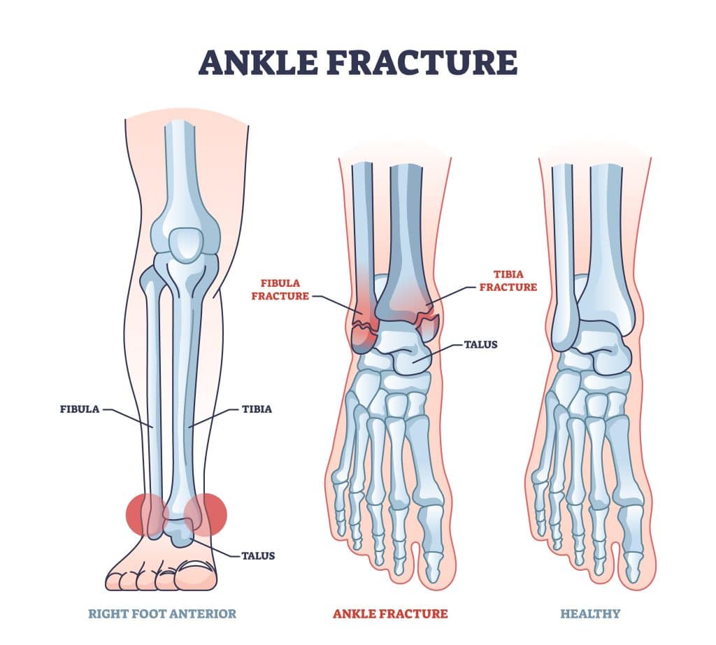 Medical illustration of types of ankle fractures