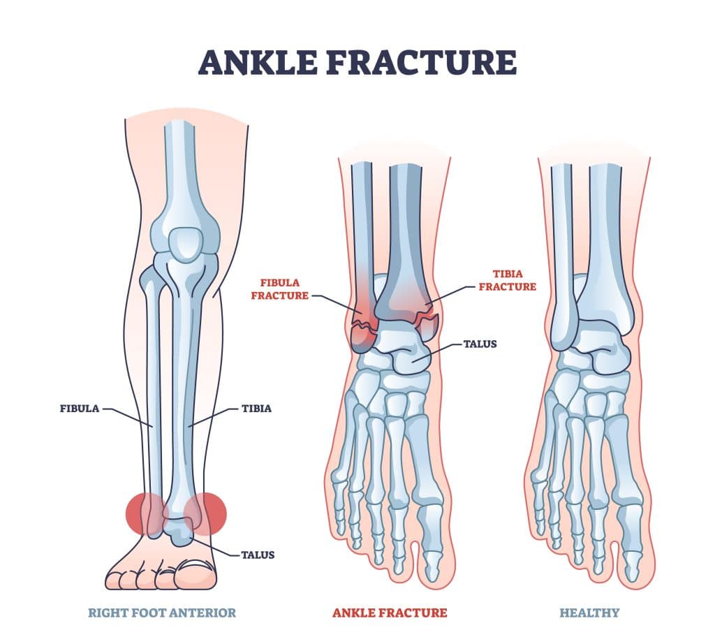 Broken Ankle: Symptoms, Causes, & Treatments - Heiden Orthopedics