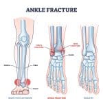 Medical illustration of types of ankle fractures
