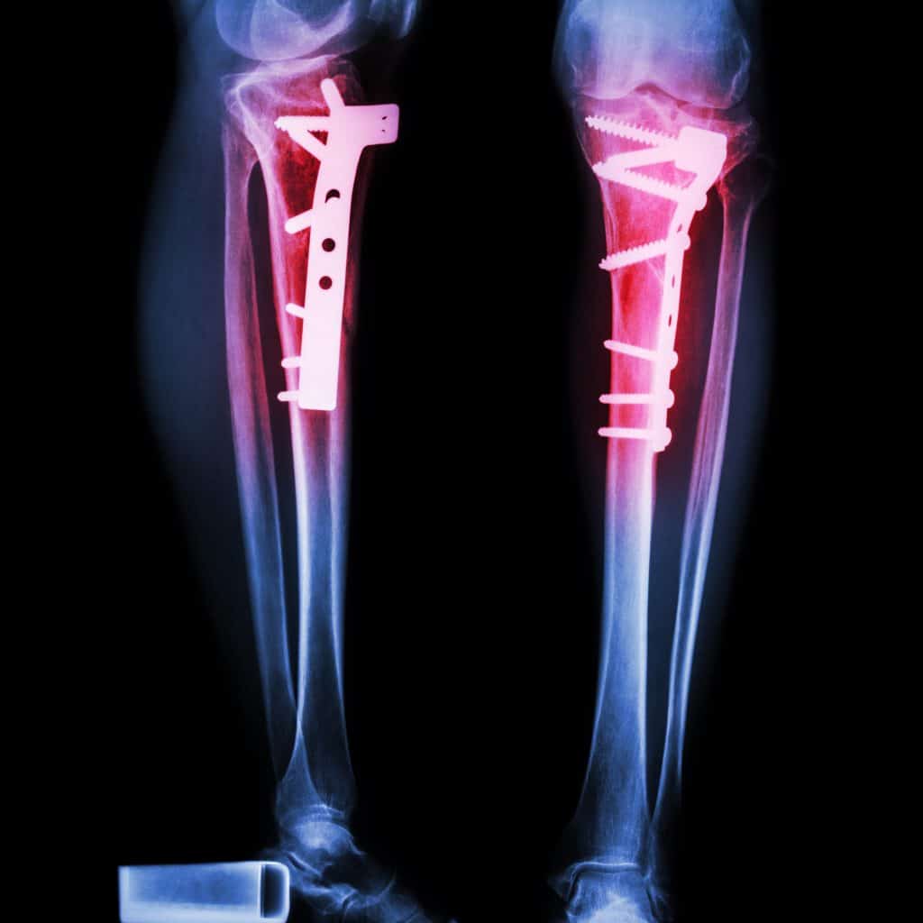 fractured tibia operated on by internal fixation with plate and screw