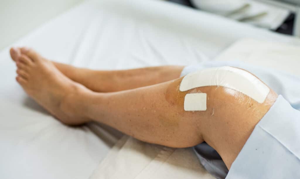 Close-up of patient on the bed in hospital after knee replacement surgery