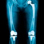 X-ray of patient with two knee replacements and a hip replacement