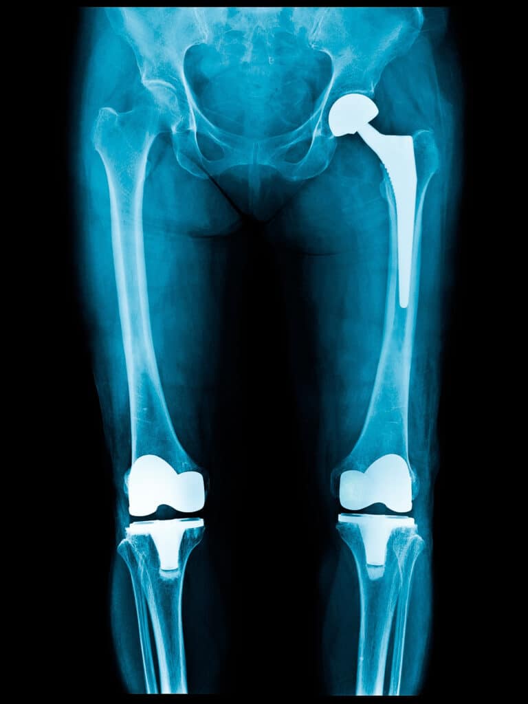 X-ray of patient with two knee replacements and a hip replacement