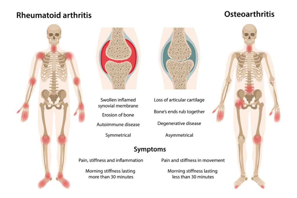 Illustration of osteoarthritis vs rheumatoid arthritis with a list of symptoms