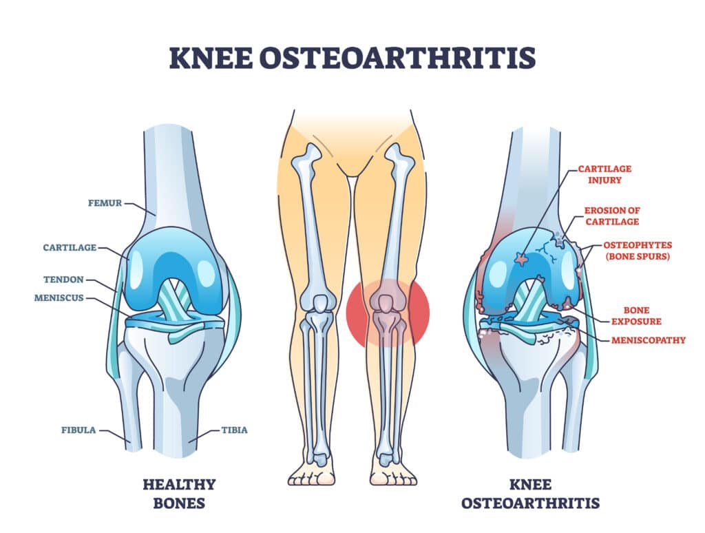 Medical illustration of symtpoms of knee osteoarthritis