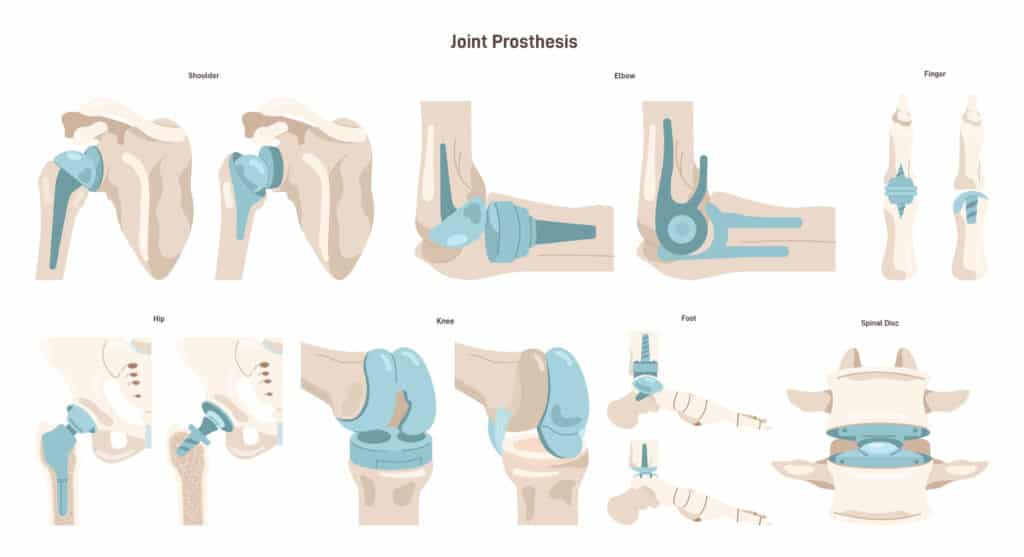 Illustration of prosthetic joints for shoulder, elbow, finger, hip, knee, foot, and spinal disc replacement