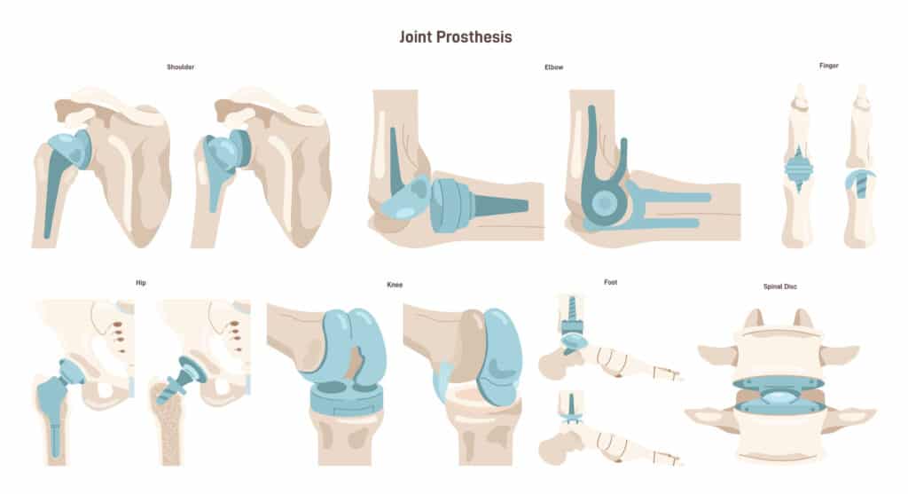 Joint Replacement Surgery