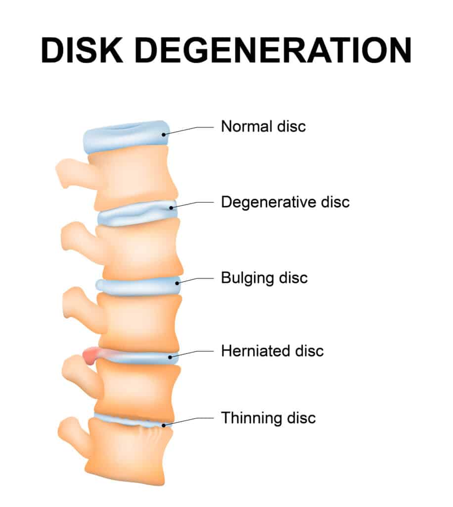 Disc degeneration illustration showing the normal wear and tear process of an aging spine, including a normal disc, degenerative disc, bulging disc, herniated disc, and thinning disc