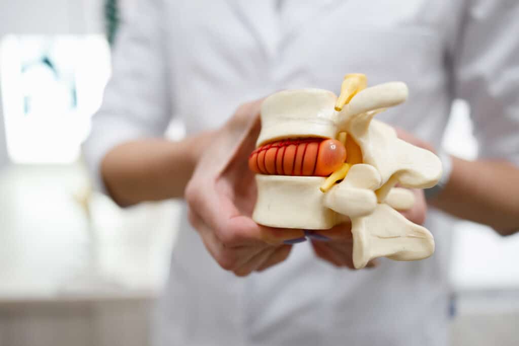 A spine specialist holding a model of a herniated lumbar disc of the spine