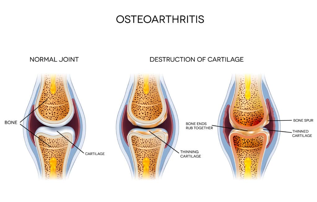 Medical illustration of the destruction of articular cartilage of the knee leading to osteoarthritis.