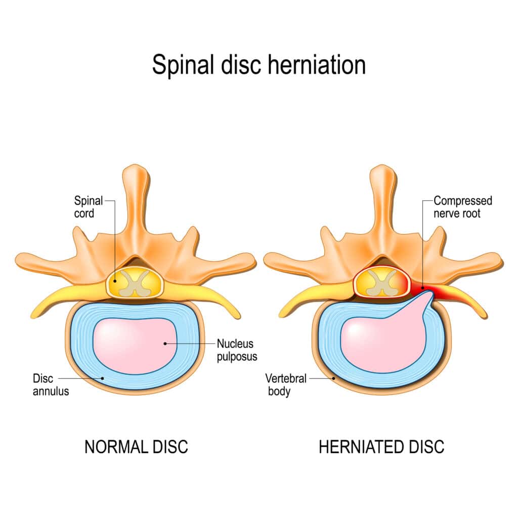 Illustration of spinal disc herniation showing both a normal disc and a herniated disc with a compressed nerve root.