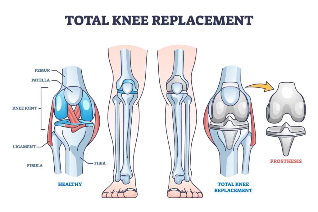 An illustration of a healthy knee and a knee after total knee replacement using a prothesic joint.