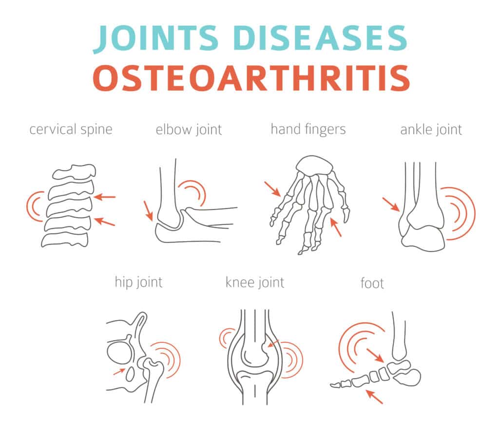 Medical illustration showing the most common joints affected by osteoarthritis, which may benefit from osteoarthritis surgery.