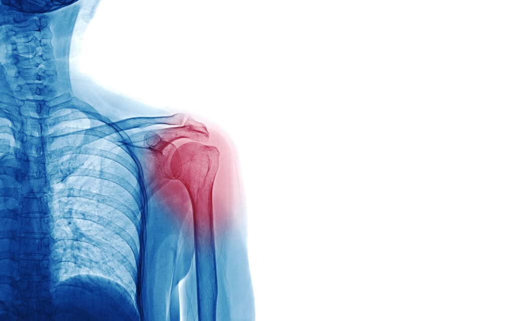 An X-ray of a person with shoulder pain, which can be caused by a bone spur in the shoulder.