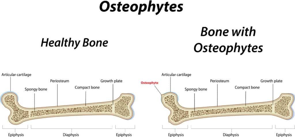 A medical illustration of a healthy bone and a bone with an osteophyte or bone spur.